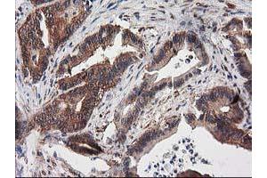Immunohistochemical staining of paraffin-embedded Adenocarcinoma of Human colon tissue using anti-DSTN mouse monoclonal antibody. (Destrin anticorps)