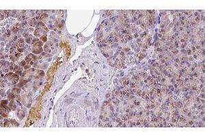 ABIN6273270 at 1/100 staining Human pancreas cancer tissue by IHC-P.