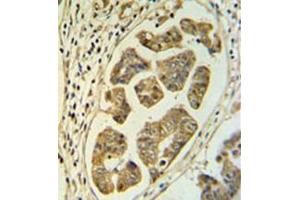 Immunohistochemistry analysis in formalin fixed and paraffin embedded colon carcinoma reacted with HCCS / CCHL Antibody (Center) followed which was peroxidase conjugated to the secondary antibody and followed by DAB staining.