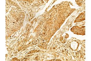 ABIN6263306 and ABIN6266597 at 1/100 staining Human lung cancer by IHC-P. (MMP7 anticorps  (C-Term))