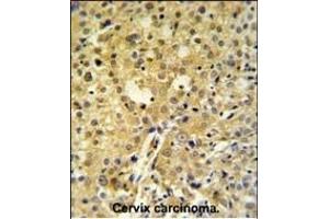 C2orf49 Antibody (N-term) (ABIN651382 and ABIN2840213) IHC analysis in formalin fixed and paraffin embedded human cervix carcinoma followed by peroxidase conjugation of the secondary antibody and DAB staining. (C2orf49 anticorps  (N-Term))