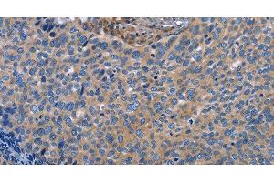 Immunohistochemistry of paraffin-embedded Human cervical cancer using INTS10 Polyclonal Antibody at dilution of 1:50 (INTS10 anticorps)