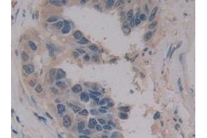 Detection of MPG1 in Human Breast cancer Tissue using Polyclonal Antibody to Macrophage Expressed Gene 1 Protein (MPG1) (MPEG1 anticorps  (AA 313-580))
