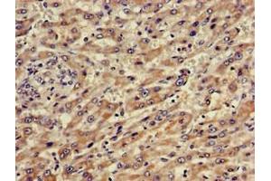 Immunohistochemistry of paraffin-embedded human liver cancer using ABIN7144881 at dilution of 1:100 (ABCA5 anticorps  (AA 1230-1355))