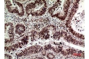 Immunohistochemistry (IHC) analysis of paraffin-embedded Human Colon Cancer, antibody was diluted at 1:100. (p53 anticorps  (Internal Region))