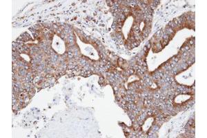 IHC-P Image Immunohistochemical analysis of paraffin-embedded human endo mitral ovarian cancer, using CPNE3, antibody at 1:100 dilution. (Copine III anticorps)
