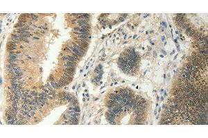 Immunohistochemistry of paraffin-embedded Human colon cancer tissue using SOCS5 Polyclonal Antibody at dilution 1:35 (SOCS5 anticorps)