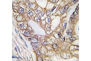 IHC analysis of FFPE human lung carcinoma tissue stained with Ihh antibody