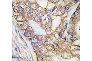 IHC analysis of FFPE human lung carcinoma tissue stained with Ihh antibody (Indian Hedgehog anticorps  (AA 1-30))