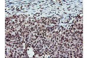 Immunohistochemical staining of paraffin-embedded Adenocarcinoma of Human ovary tissue using anti-TPSG1 mouse monoclonal antibody. (TPSG1 anticorps  (AA 20-283))