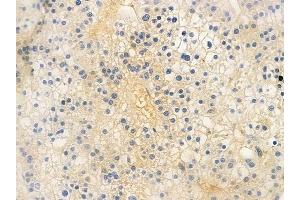 ABIN6259931 and ABIN6276398 at 1/100 staining human hepatocellular carcinoma by IHC-P. (ANGPTL3 anticorps  (N-Term))