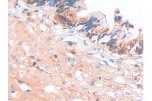 Detection of SCAF11 in Human Pancreatic cancer Tissue using Polyclonal Antibody to Protein SCAF11 (SCAF11)