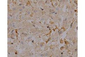 Immunohistochemical staining of human liver cancer tissue section with CAPZA1 monoclonal antibody, clone 2  at 1:100 dilution.