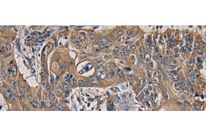 Immunohistochemistry of paraffin-embedded Human esophagus cancer tissue using CCNI Polyclonal Antibody at dilution of 1:65(x200) (Cyclin I anticorps)