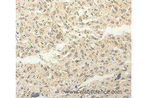 Immunohistochemistry of Human liver cancer using FZD8 Polyclonal Antibody at dilution of 1:50 (FZD8 anticorps)