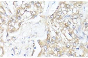 Immunohistochemistry of paraffin-embedded Human liver cancer using SMAD7 Polyclonal Antibody at dilution of 1:100 (40x lens). (SMAD7 anticorps)