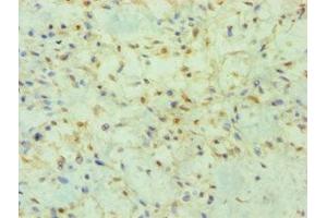 Immunohistochemistry of paraffin-embedded human breast cancer using ABIN7165066 at dilution of 1:100 (PRMT2 anticorps  (AA 1-300))