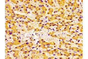 Immunohistochemistry of paraffin-embedded human liver cancer using ABIN7175433 at dilution of 1:100 (ACADVL anticorps  (AA 403-497))