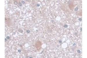 Detection of AST in Human Glioma Tissue using Monoclonal Antibody to Aspartate Aminotransferase (AST) (GOT1 anticorps  (AA 1-413))