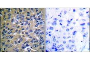 Immunohistochemistry analysis of paraffin-embedded human breast carcinoma, using IkappaB-epsilon (Phospho-Ser22) Antibody. (IkappaB-epsilon anticorps  (pSer22))