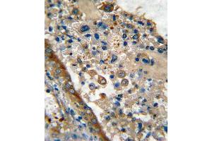 Formalin-fixed and paraffin-embedded human lung carcinoma reacted with GARP Antibody (Center), which was peroxidase-conjugated to the secondary antibody, followed by DAB staining.
