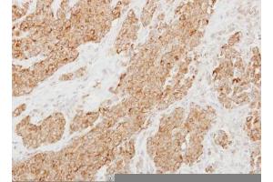 IHC-P Image Immunohistochemical analysis of paraffin-embedded human breast cancer, using Protease Inhibitor 15, antibody at 1:250 dilution. (PI15 anticorps  (C-Term))