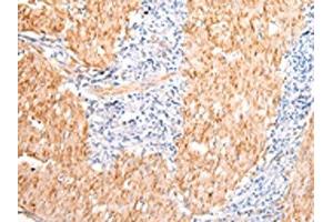 The image on the left is immunohistochemistry of paraffin-embedded Human gastric cancer tissue using ABIN7190483(DMBT1 Antibody) at dilution 1/20, on the right is treated with synthetic peptide.
