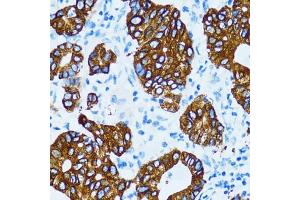 Immunohistochemistry of paraffin-embedded human gastric cancer using CTSE antibody (ABIN5971444) at dilution of 1/100 (40x lens). (Cathepsin E anticorps)