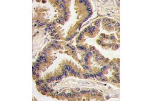 Formalin-fixed and paraffin-embedded human lung carcinoma tissue reacted with Bmp6 antibody (N-term) (ABIN388456 and ABIN2848818) , which was peroxidase-conjugated to the secondary antibody, followed by DAB staining.