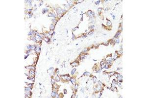 Immunohistochemistry of paraffin-embedded human lung cancer using ErbB2 antibody.