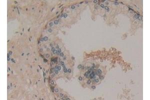Detection of 0 in Human Prostate Tissue using Polyclonal Antibody to Superoxide Dismutase Copper Chaperone