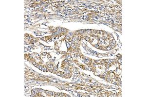 Immunohistochemistry of paraffin-embedded human lung cancer using S Rabbit mAb (ABIN7270501) at dilution of 1:250 (40x lens). (SAMM50 anticorps)