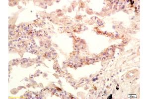 Formalin-fixed and paraffin embedded human lung carcinoma labeled with Anti-GPS1/CSN1 Polyclonal Antibody, Unconjugated (ABIN1385980) at 1:200 followed by conjugation to the secondary antibody and DAB staining. (GPS1 anticorps  (AA 324-370))