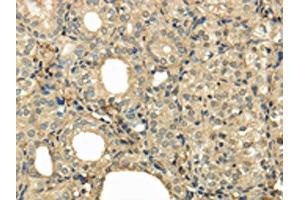 The image on the left is immunohistochemistry of paraffin-embedded Human thyroid cancer tissue using ABIN7128055(UBE2B Antibody) at dilution 1/30, on the right is treated with fusion protein. (UBE2B anticorps)