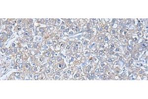 Immunohistochemistry of paraffin-embedded Human liver cancer tissue using TREM1 Polyclonal Antibody at dilution of 1:50(x200) (TREM1 anticorps)