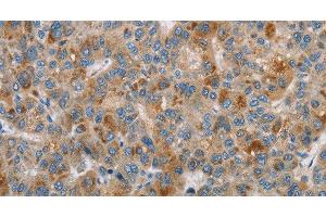 Immunohistochemistry of paraffin-embedded Human liver cancer using DBH Polyclonal Antibody at dilution of 1:70