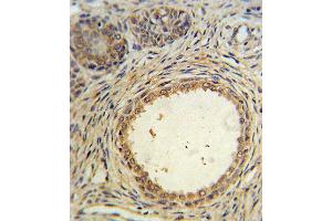 AMH Antibody IHC analysis in formalin fixed and paraffin embedded prostate carcinoma followed by peroxidase conjugation of the secondary antibody and DAB staining. (AMH anticorps  (AA 424-451))