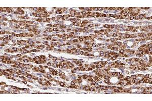 ABIN6279850 at 1/100 staining Human liver cancer tissue by IHC-P.