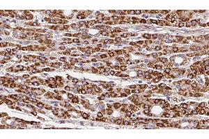 ABIN6279850 at 1/100 staining Human liver cancer tissue by IHC-P. (SLC28A1 anticorps  (N-Term))