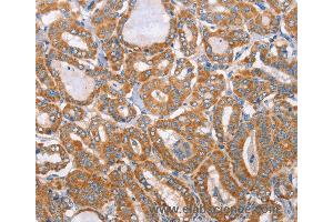 Immunohistochemistry of Human colon cancer using MTMR7 Polyclonal Antibody at dilution of 1:40 (MTMR7 anticorps)