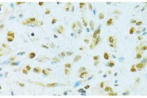 Immunohistochemistry of paraffin-embedded Human gastric cancer using RCC1 Polyclonal Antibody at dilution of 1:100 (40x lens).