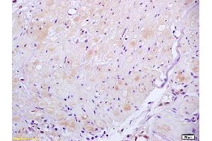Formalin-fixed and paraffin embedded human gastric carcinoma tissue labeled with Anti ROCK2 Polyclonal Antibody, unconjugated (ABIN673359) at 1:200 followed by incubation with conjugated secondary antibody and DAB staining (ROCK2 anticorps  (AA 1001-1300))