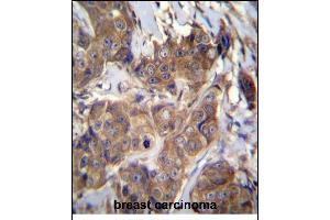 ATP6V1B1 Antibody (C-term) (ABIN656224 and ABIN2845541) immunohistochemistry analysis in formalin fixed and paraffin embedded human breast carcinoma followed by peroxidase conjugation of the secondary antibody and DAB staining. (ATP6V1B1 anticorps  (C-Term))