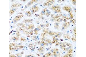 Immunohistochemistry of paraffin-embedded Human liver cancer using KIAA1456 Polyclonal Antibody at dilution of 1:200 (40x lens).