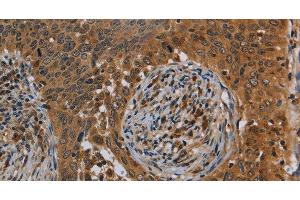 Immunohistochemistry of paraffin-embedded Human cervical cancer tissue using OSM Polyclonal Antibody at dilution 1:40 (Oncostatin M anticorps)