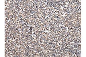 The image on the left is immunohistochemistry of paraffin-embedded Human tonsil tissue using ABIN7128064(UGGT2 Antibody) at dilution 1/20, on the right is treated with fusion protein.