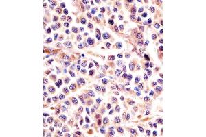 (ABIN6242397 and ABIN6578004) staining IL24 in human melanoma sections by Immunohistochemistry (IHC-P - paraformaldehyde-fixed, paraffin-embedded sections). (IL-24 anticorps)