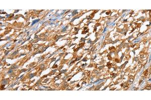 Immunohistochemistry of paraffin-embedded Human esophagus cancer using CAPG Polyclonal Antibody at dilution of 1:40 (CAPG anticorps)