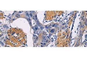 Immunohistochemistry of paraffin-embedded Human esophagus cancer tissue using FAM20C Polyclonal Antibody at dilution of 1:45(x200) (FAM20C anticorps)