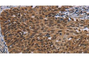 Immunohistochemistry of paraffin-embedded Human cervical cancer using CEBPD Polyclonal Antibody at dilution of 1:40